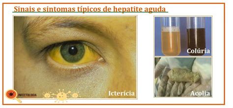 sintomas de hepatite aguda